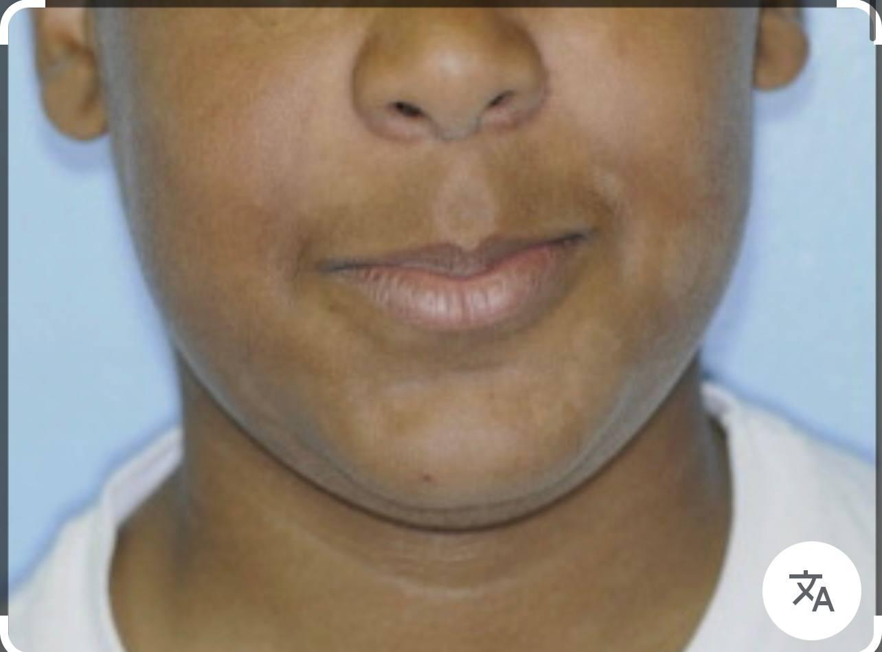 Tinea Versicolor፡ መንስኤዎች፣ ምርመራዎች እና የሕክምና አማራጮች